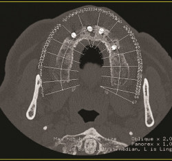 Imaging delle perimplantiti