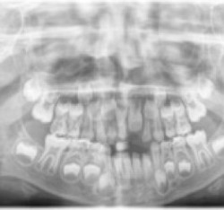 Early Treatment della III Classe associata a Macroglossia