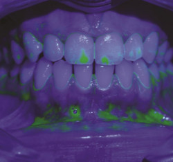 Approccio cognitivo comportamentale  nel Tailored Brushing Method