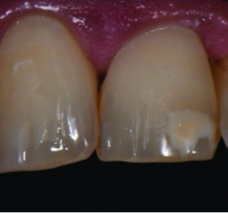 Management delle  White Spot Lesions