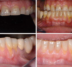 Il dinamismo dei protocolli operativi di prevenzione  domiciliare e professionale per il ripristino della salute  del cavo orale pre trattamento chirurgico implantare:  un case report