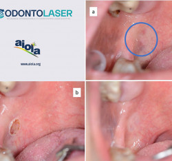 Semplificazione delle procedure chirurgiche dei tessuti molli del terzo posteriore del cavo orale mediante laser a diodo: CASE REPORT
