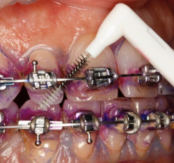 Importanza dell'igiene orale  in presenza di terapia ortodontica