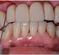 Mucosite e Ozonoterapia