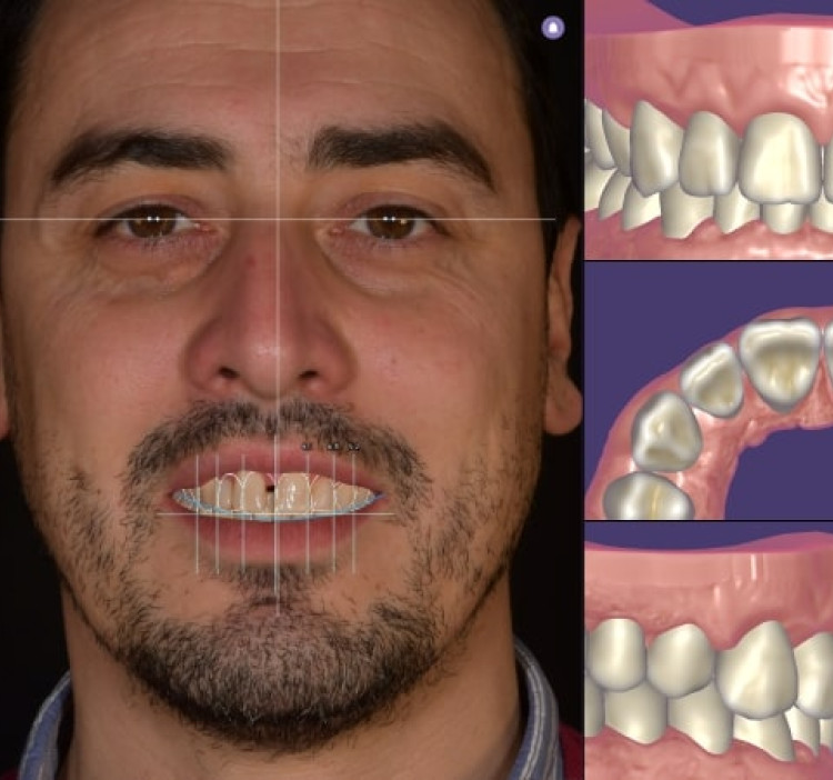 exocad - consigli e trucchi per DentalCAD Elefsina