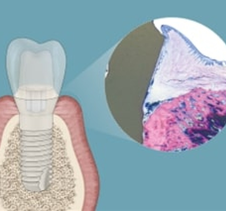 In che modo Patent™ può prevenire la perimplantite?